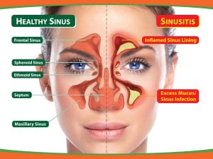 Sinus Problems