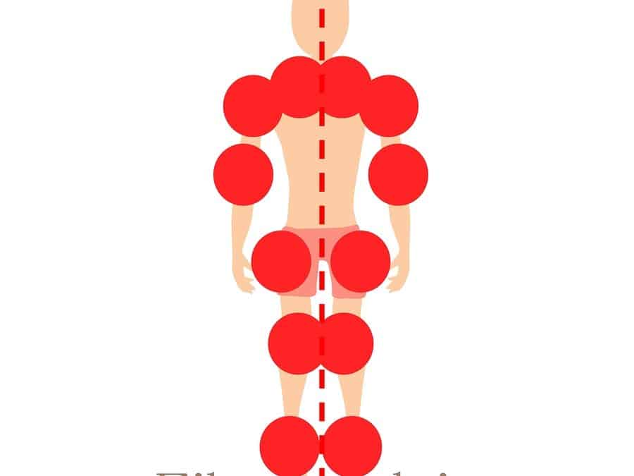 Relieving Trigger Points For Fibromyalgia Pain