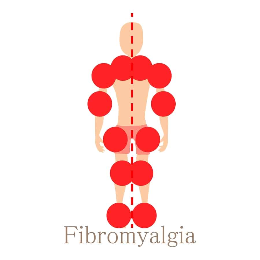 trigger points for Fibromyalgia chart