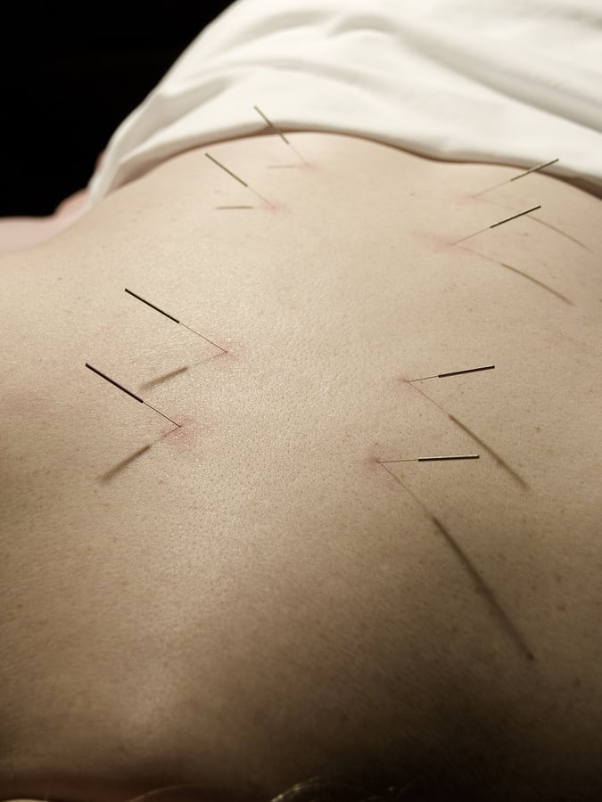 person with acupuncture needles in back