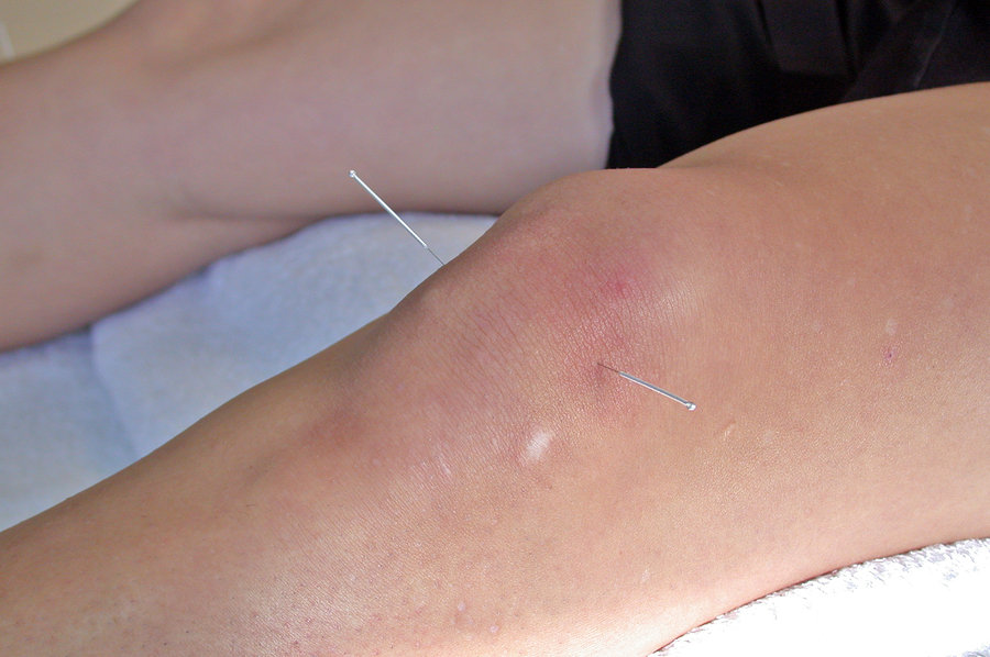 Acupuncture - Knee With 2 Needles