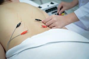 Electro-acupuncture for Low Back Pain